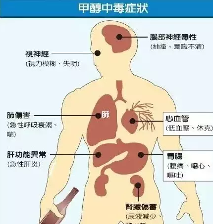 甲醇后期中毒癥狀